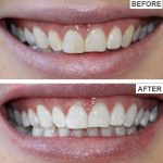 JOYTEETH